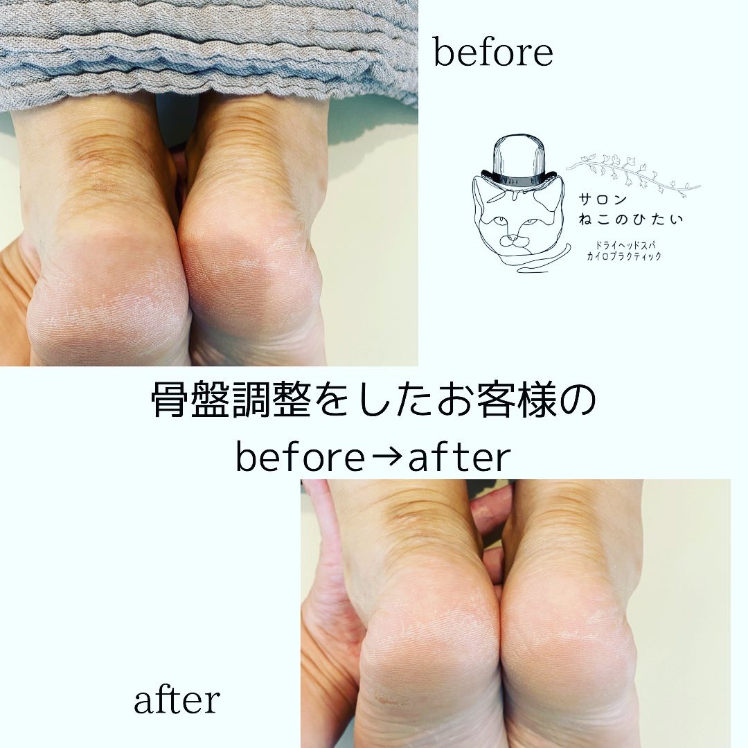 骨盤調整 before / after